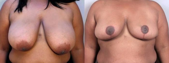 Breast Reduction Case 508 Before & After View #1 | Paramus, New Jersey | Parker Center for Plastic Surgery