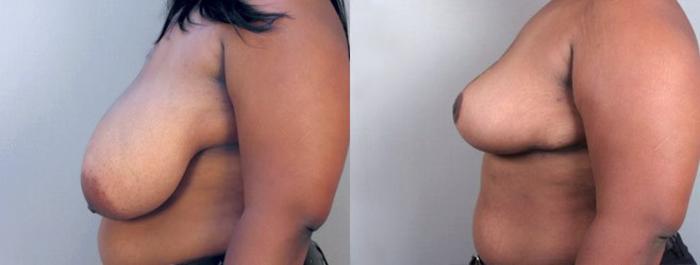 Breast Reduction Case 508 Before & After View #2 | Paramus, New Jersey | Parker Center for Plastic Surgery
