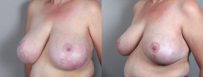 Breast Asymmetry Case 510 Before & After View #2 | Paramus, New Jersey | Parker Center for Plastic Surgery