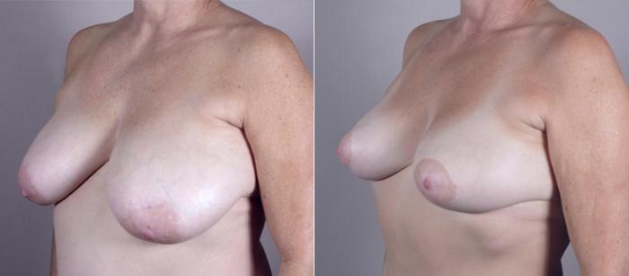 Breast Asymmetry Case 511 Before & After View #2 | Paramus, New Jersey | Parker Center for Plastic Surgery