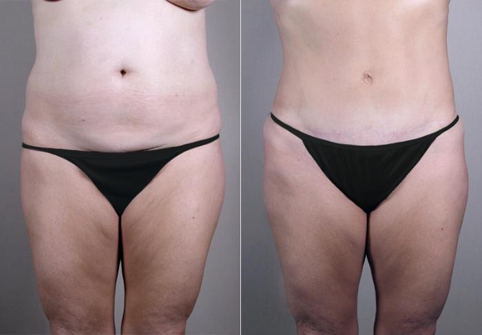 Breast Asymmetry Case 511 Before & After View #3 | Paramus, New Jersey | Parker Center for Plastic Surgery