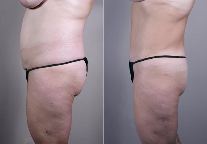 Breast Asymmetry Case 511 Before & After View #4 | Paramus, New Jersey | Parker Center for Plastic Surgery