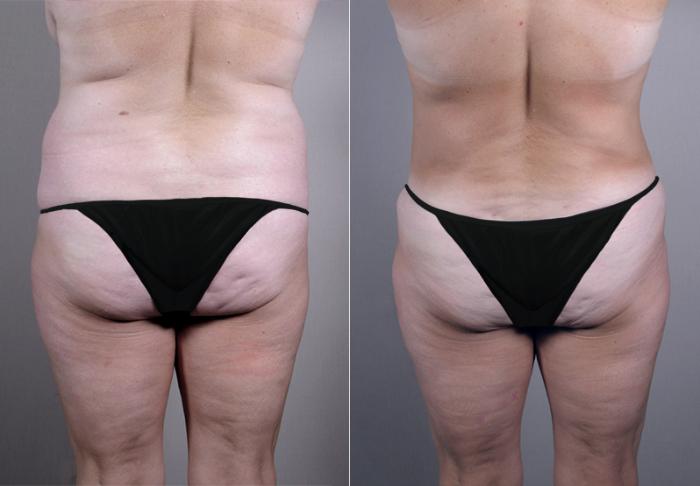Breast Asymmetry Case 511 Before & After View #5 | Paramus, New Jersey | Parker Center for Plastic Surgery