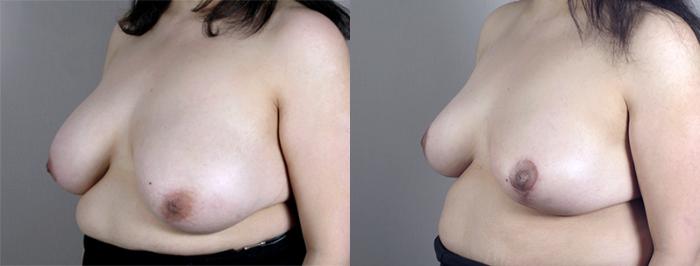 Breast Lift Case 512 Before & After View #2 | Paramus, New Jersey | Parker Center for Plastic Surgery