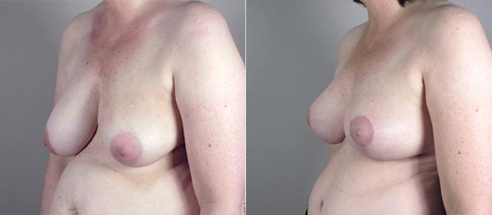 Breast Asymmetry Case 513 Before & After View #2 | Paramus, New Jersey | Parker Center for Plastic Surgery