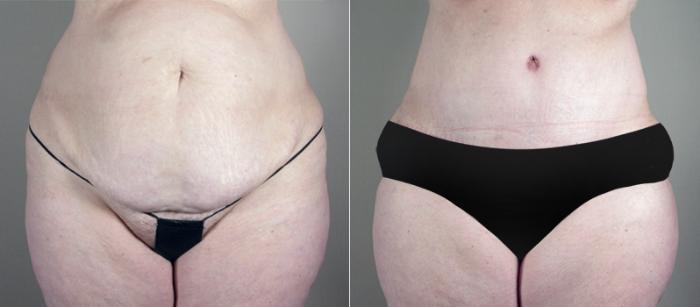Breast Asymmetry Case 513 Before & After View #3 | Paramus, New Jersey | Parker Center for Plastic Surgery