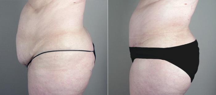 Breast Asymmetry Case 513 Before & After View #4 | Paramus, New Jersey | Parker Center for Plastic Surgery