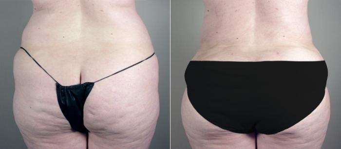 Breast Asymmetry Case 513 Before & After View #5 | Paramus, New Jersey | Parker Center for Plastic Surgery