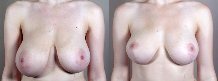 Breast Asymmetry Case 515 Before & After View #2 | Paramus, New Jersey | Parker Center for Plastic Surgery