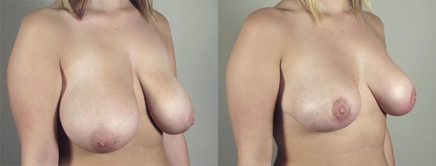 Breast Asymmetry Case 516 Before & After View #2 | Paramus, New Jersey | Parker Center for Plastic Surgery