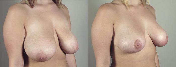 Breast Lift with Auto Aug Case 516 Before & After View #2 | Paramus, New Jersey | Parker Center for Plastic Surgery