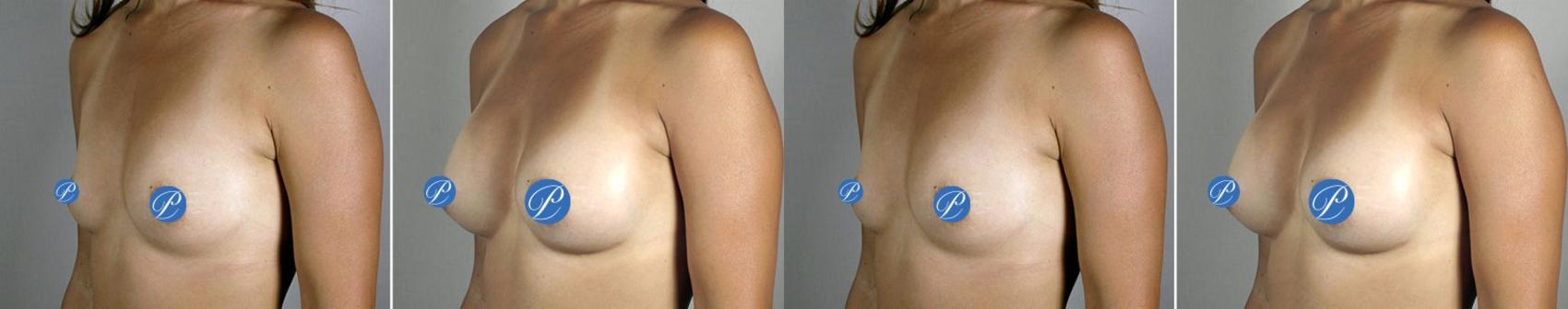 Breast Asymmetry Case 901 Before & After View #4 | Paramus, New Jersey | Parker Center for Plastic Surgery