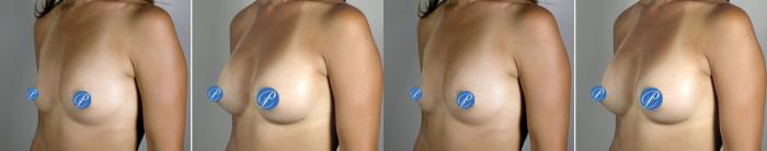 Breast Asymmetry Case 901 Before & After View #4 | Paramus, New Jersey | Parker Center for Plastic Surgery