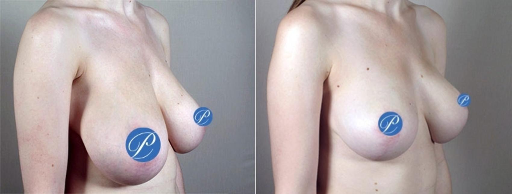 Breast Asymmetry Case 903 Before & After View #5 | Paramus, New Jersey | Parker Center for Plastic Surgery
