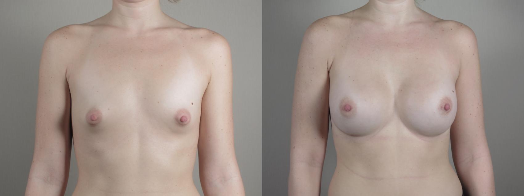 Breast Augmentation Case 1000 Before & After Front | Paramus, New Jersey | Parker Center for Plastic Surgery