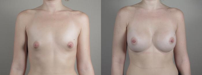 Breast Augmentation Case 1000 Before & After Front | Paramus, New Jersey | Parker Center for Plastic Surgery