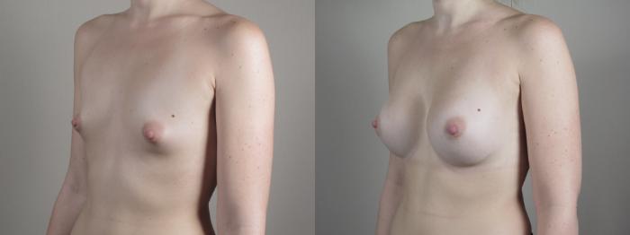 Breast Augmentation Case 1000 Before & After Right Oblique | Paramus, New Jersey | Parker Center for Plastic Surgery