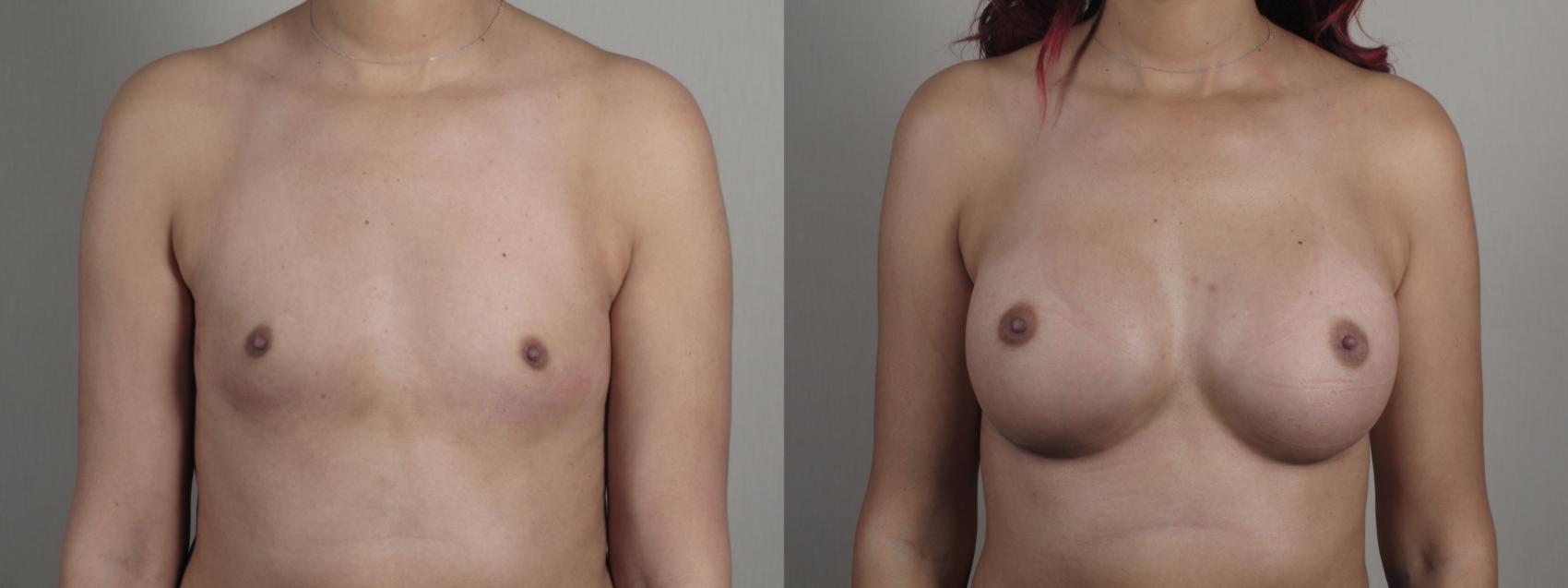 Breast Augmentation Case 1001 Before & After Front | Paramus, New Jersey | Parker Center for Plastic Surgery