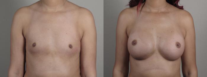 Breast Augmentation Case 1001 Before & After Front | Paramus, New Jersey | Parker Center for Plastic Surgery