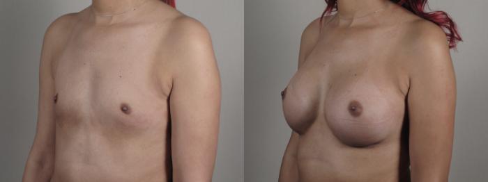 Breast Augmentation Case 1001 Before & After Right Oblique | Paramus, New Jersey | Parker Center for Plastic Surgery