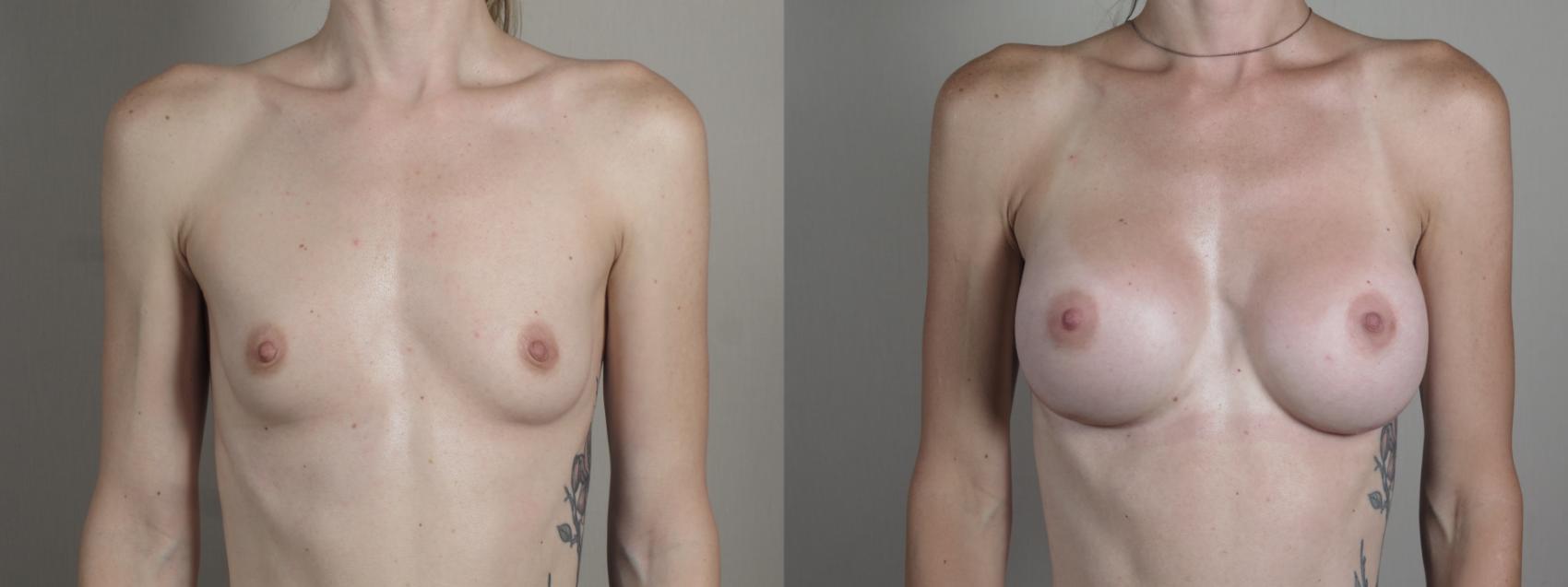 Breast Augmentation Case 1002 Before & After Front | Paramus, New Jersey | Parker Center for Plastic Surgery