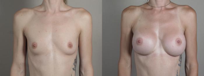 Breast Augmentation Case 1002 Before & After Front | Paramus, New Jersey | Parker Center for Plastic Surgery