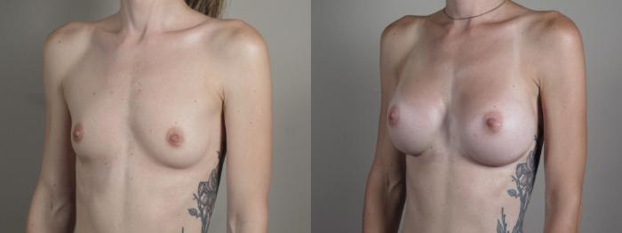 Breast Augmentation Case 1002 Before & After Right Oblique | Paramus, New Jersey | Parker Center for Plastic Surgery
