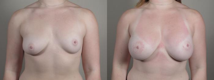 Breast Augmentation Case 1003 Before & After Front | Paramus, New Jersey | Parker Center for Plastic Surgery