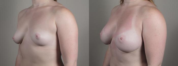 Breast Augmentation Case 1003 Before & After Right Oblique | Paramus, New Jersey | Parker Center for Plastic Surgery