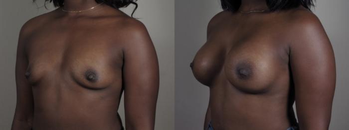 Breast Augmentation Case 1007 Before & After Right Oblique | Paramus, New Jersey | Parker Center for Plastic Surgery
