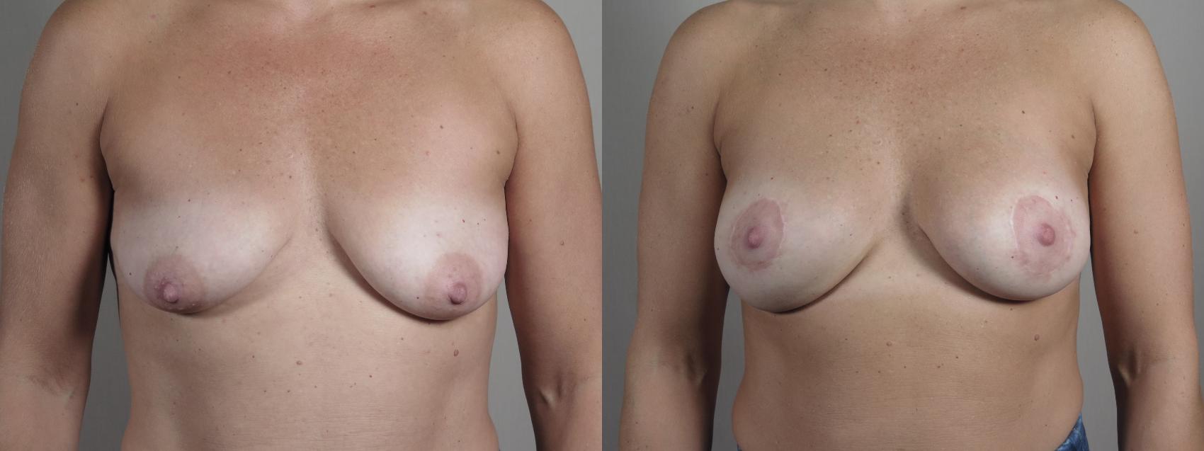 Breast Augmentation Case 1022 Before & After Front | Paramus, New Jersey | Parker Center for Plastic Surgery