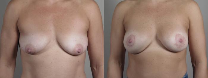 Breast Augmentation Case 1022 Before & After Front | Paramus, New Jersey | Parker Center for Plastic Surgery