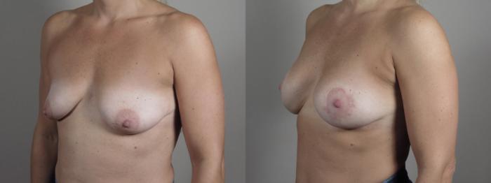 Breast Augmentation Case 1022 Before & After Right Oblique | Paramus, New Jersey | Parker Center for Plastic Surgery