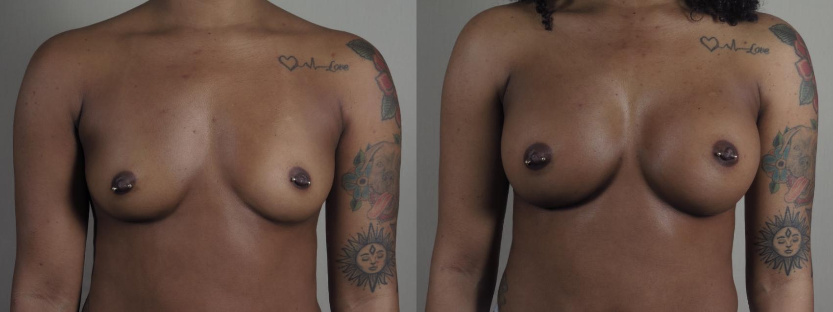 Breast Augmentation Case 1200 Before & After View #1  | Paramus, New Jersey | Parker Center for Plastic Surgery