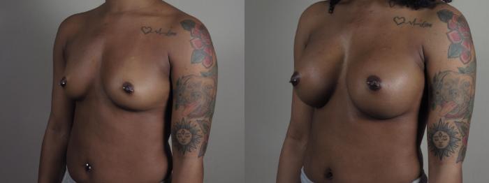 Breast Augmentation Case 1200 Before & After View #2 | Paramus, New Jersey | Parker Center for Plastic Surgery