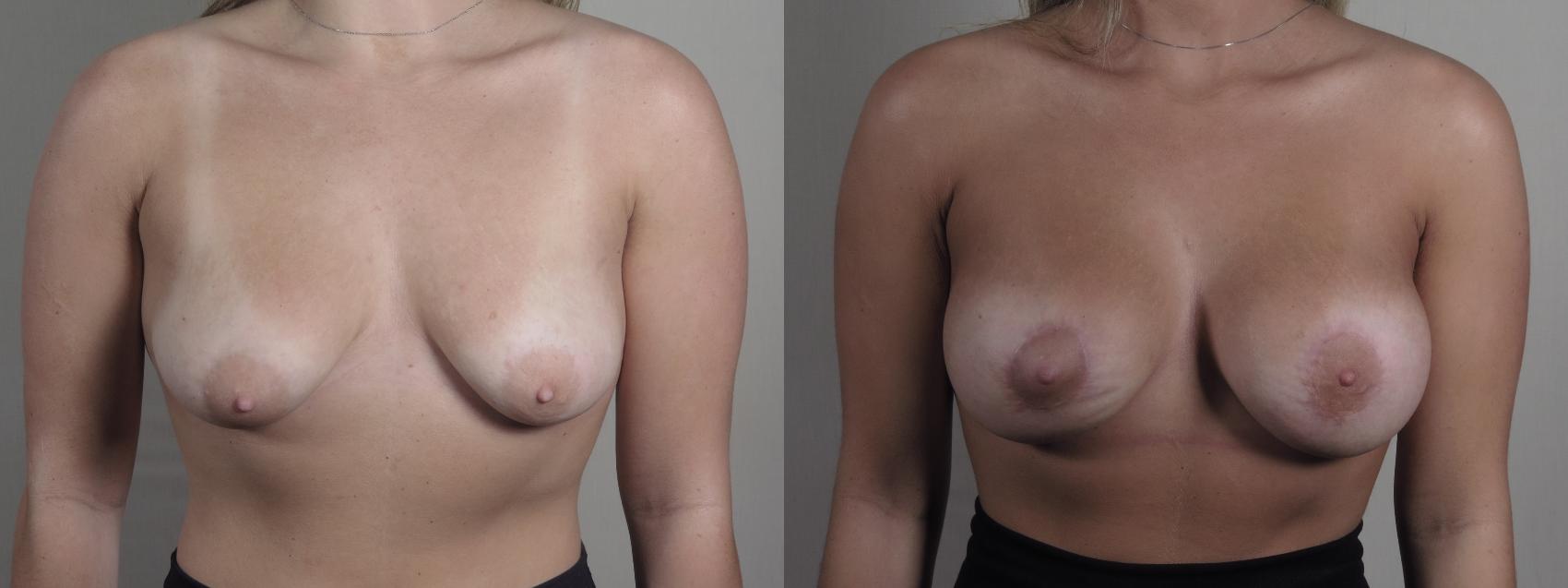 Breast Augmentation Case 1272 Before & After Front | Paramus, New Jersey | Parker Center for Plastic Surgery