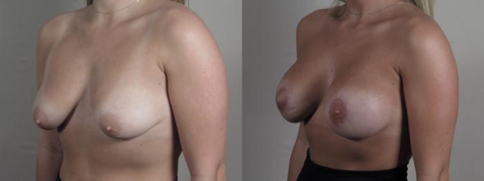 Breast Augmentation Case 1272 Before & After Left Oblique | Paramus, New Jersey | Parker Center for Plastic Surgery