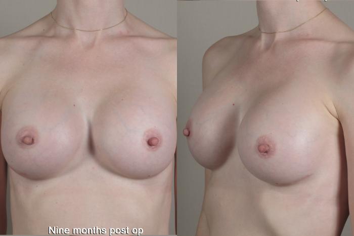 Breast Augmentation Case 1357 Before & After months  | Paramus, New Jersey | Parker Center for Plastic Surgery