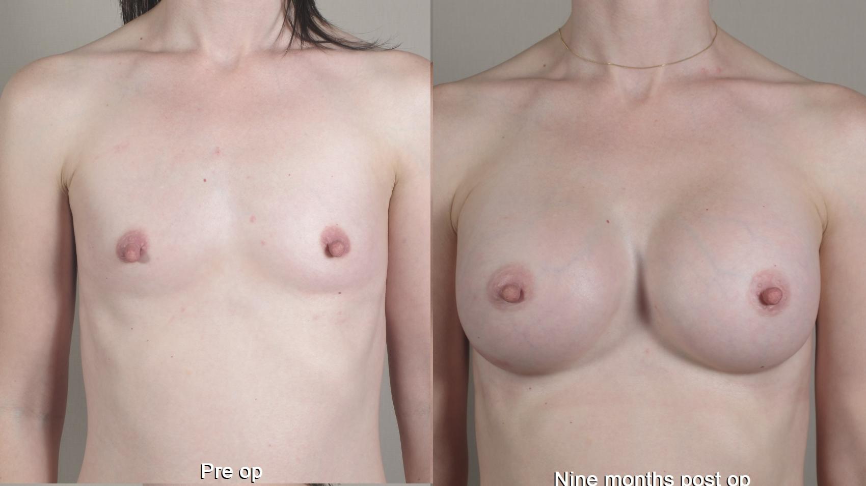 Breast Augmentation Case 1357 Before & After pre op  | Paramus, New Jersey | Parker Center for Plastic Surgery