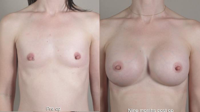 Breast Augmentation Case 1357 Before & After pre op  | Paramus, New Jersey | Parker Center for Plastic Surgery
