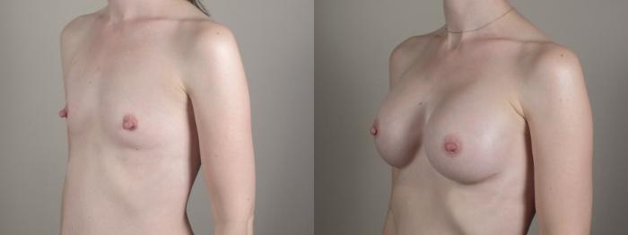 Breast Augmentation Case 1357 Before & After pre op post op | Paramus, New Jersey | Parker Center for Plastic Surgery