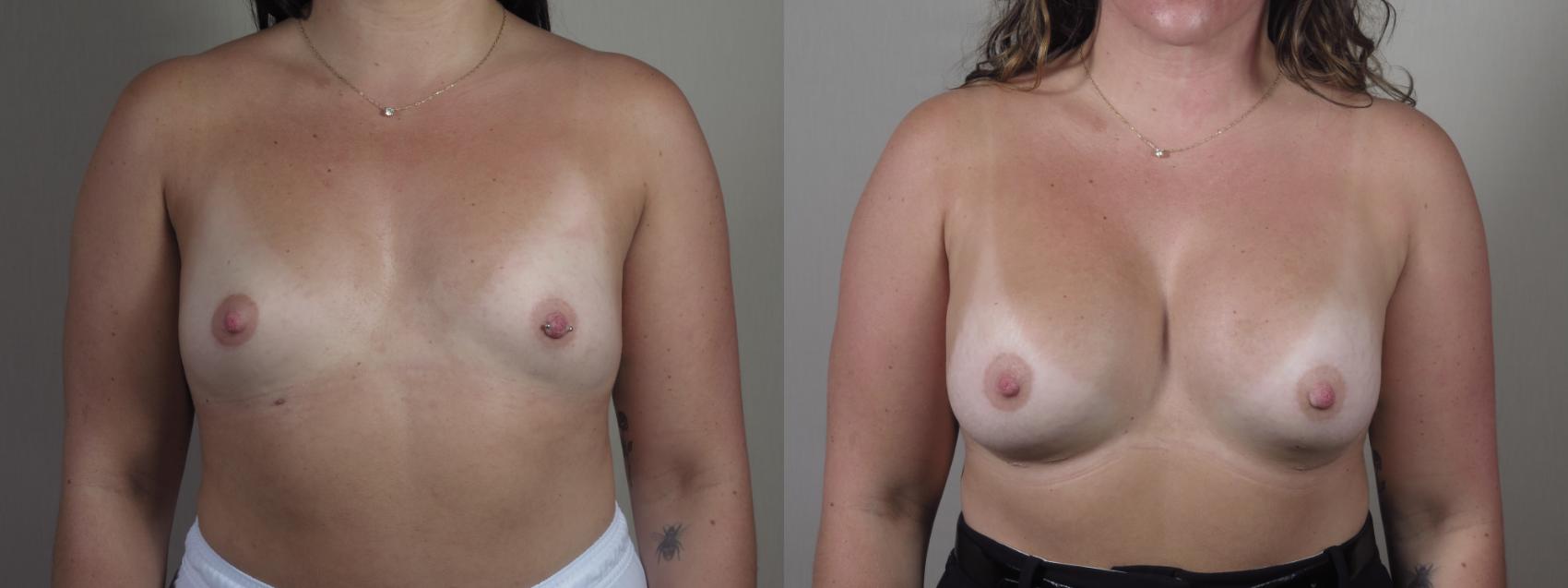 Breast Augmentation Case 1425 Before & After Front | Paramus, New Jersey | Parker Center for Plastic Surgery