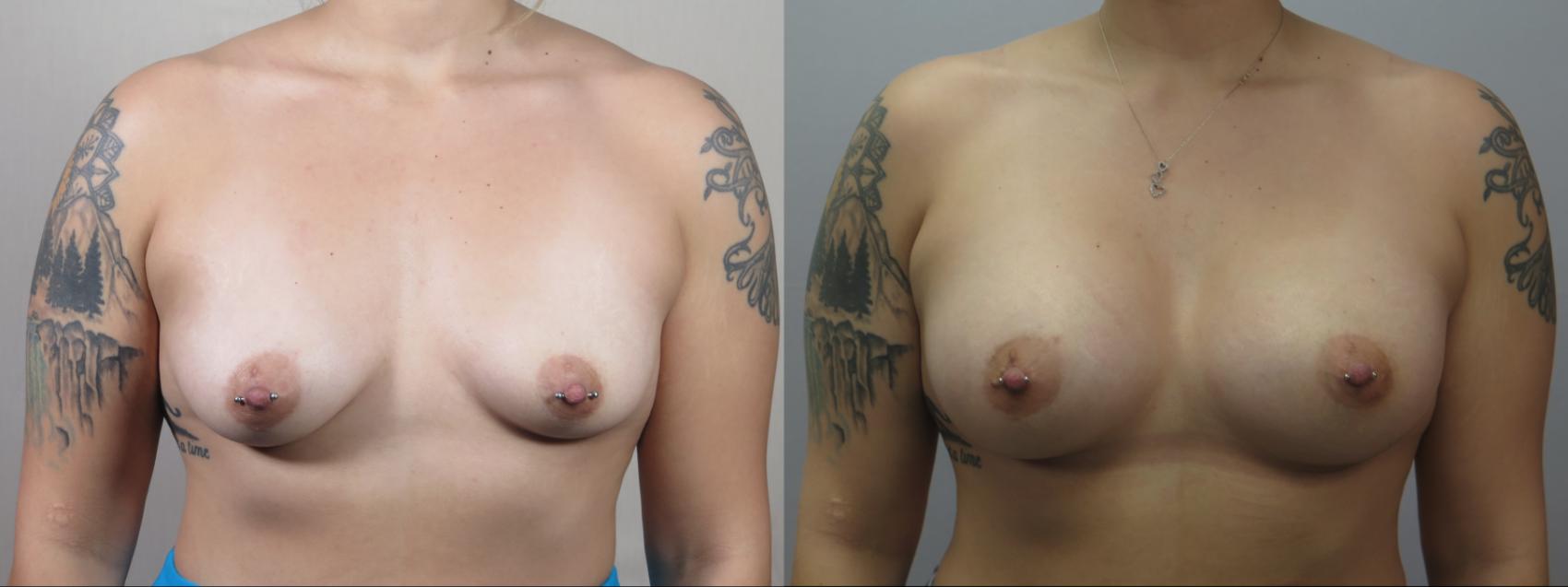 Breast Augmentation Case 1639 Before & After Front | Paramus, New Jersey | Parker Center for Plastic Surgery
