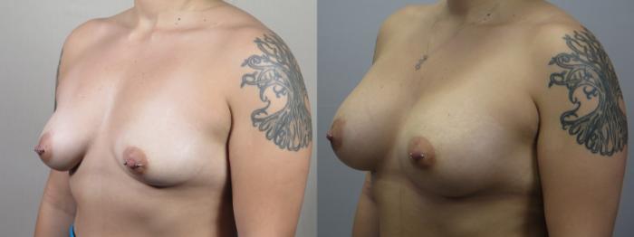 Breast Augmentation Case 1639 Before & After Left Oblique | Paramus, New Jersey | Parker Center for Plastic Surgery