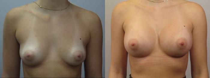 Breast Augmentation Case 1678 Before & After Front | Paramus, New Jersey | Parker Center for Plastic Surgery
