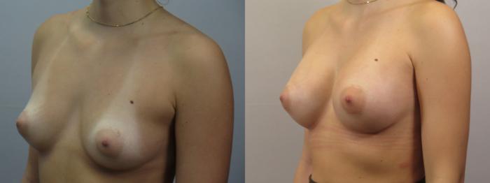 Breast Augmentation Case 1678 Before & After Left Oblique | Paramus, New Jersey | Parker Center for Plastic Surgery