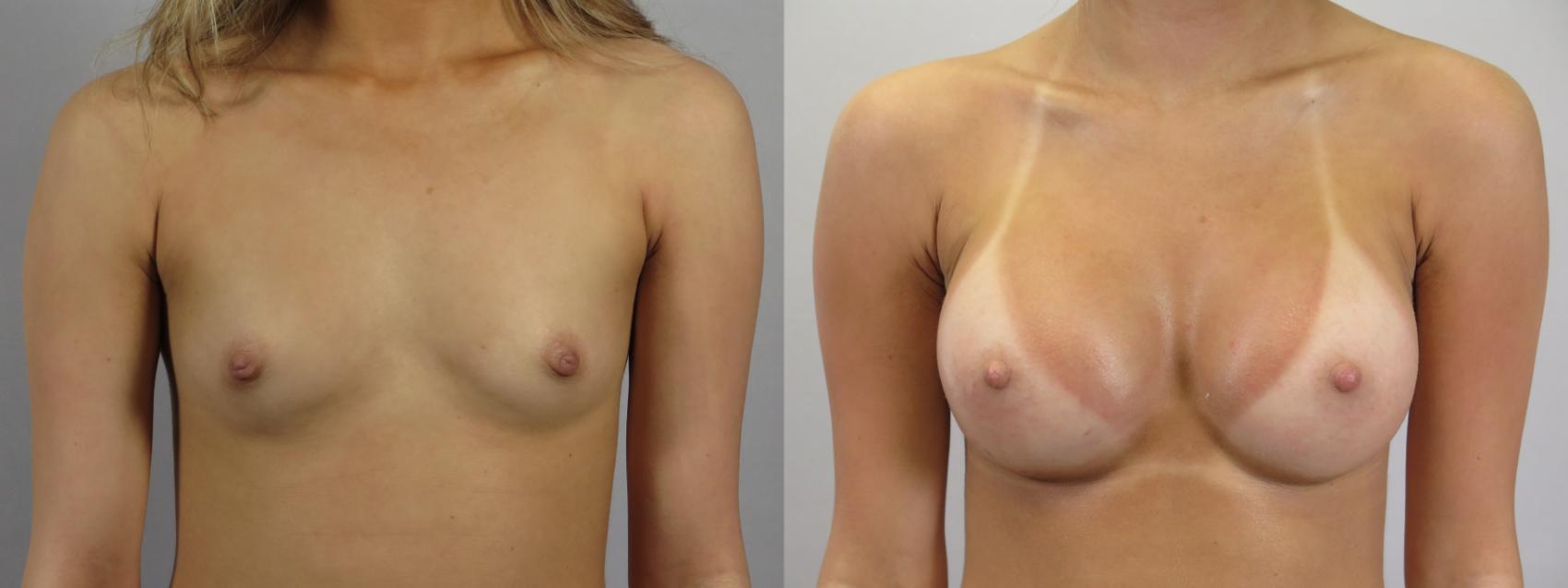 Breast Augmentation Case 1679 Before & After Front | Paramus, New Jersey | Parker Center for Plastic Surgery