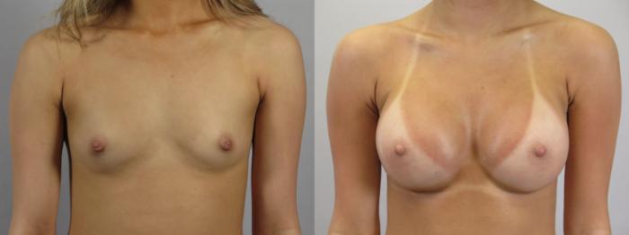 Breast Augmentation Case 1679 Before & After Front | Paramus, New Jersey | Parker Center for Plastic Surgery