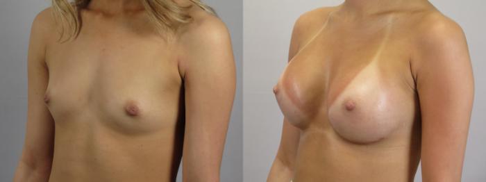 Breast Augmentation Case 1679 Before & After Left Oblique | Paramus, New Jersey | Parker Center for Plastic Surgery