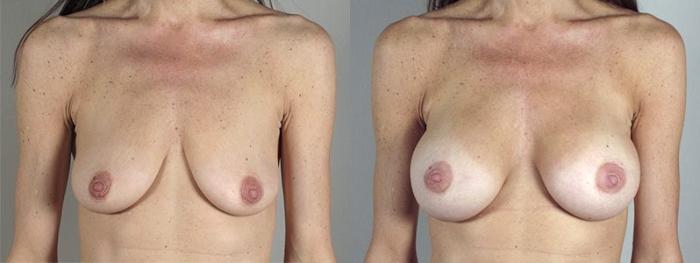 Breast Augmentation Case 346 Before & After View #1 | Paramus, New Jersey | Parker Center for Plastic Surgery
